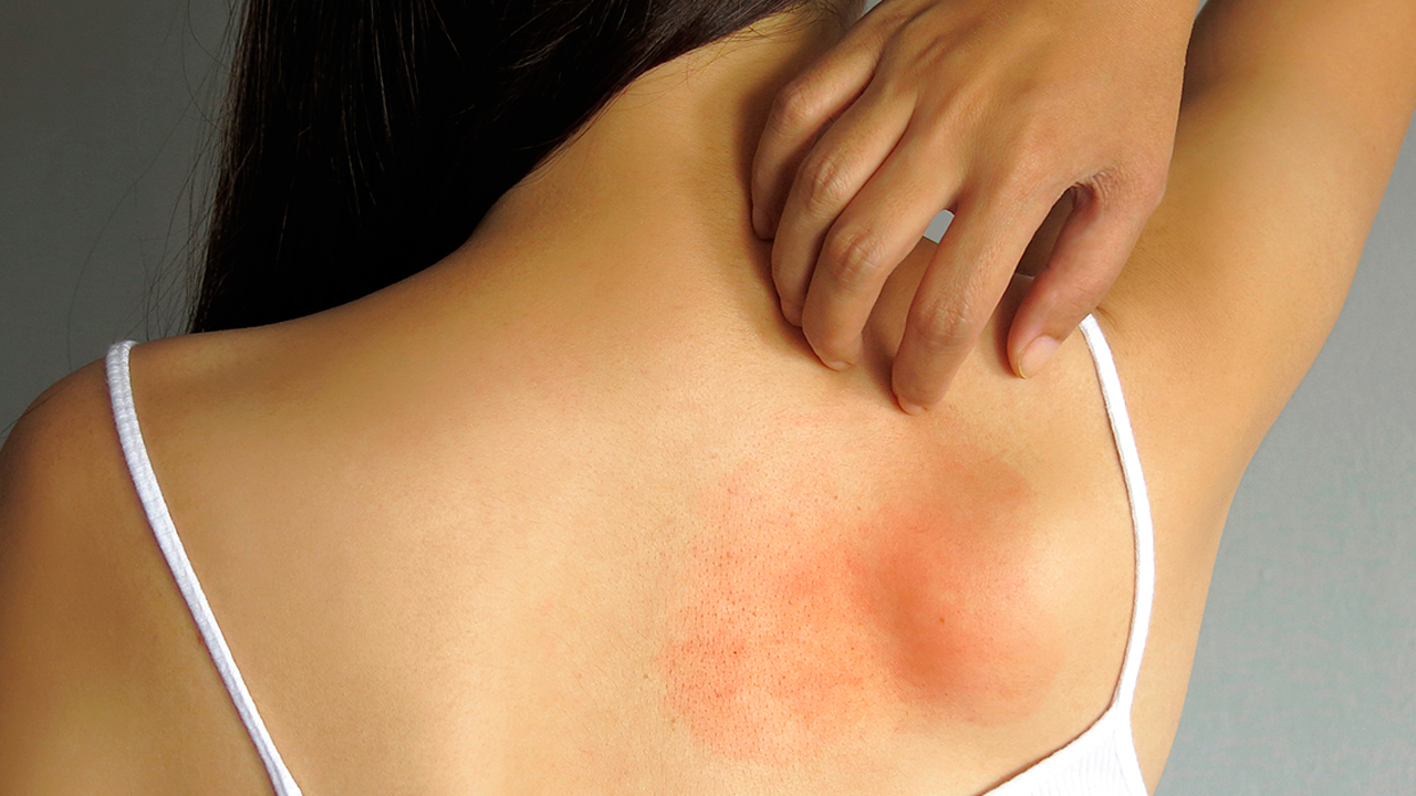 Resultado de imagen para alergias en la piel